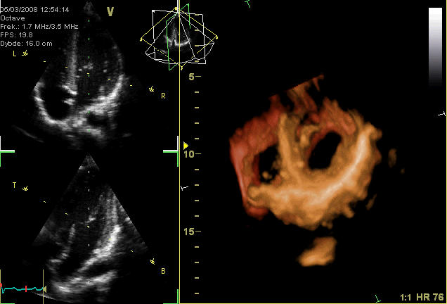 4D-Ultraschall eine schlagenden Herzens (Echokardiogramm) 