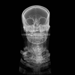 CT-Scan eines menschlichen Schädels 