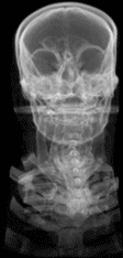CT-Scan eines menschlichen Schädels 